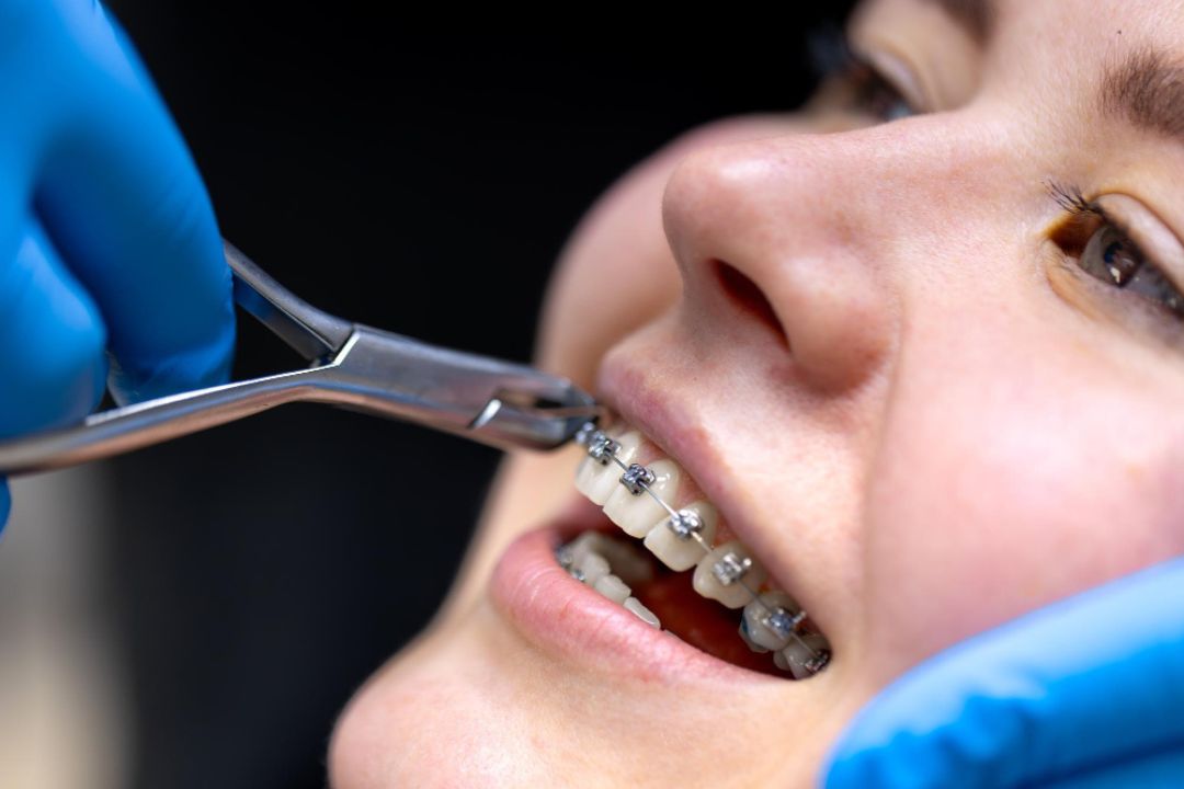 Braces treatment in Lucknow - Orthodontics